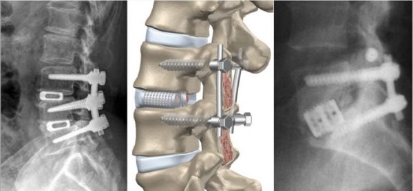 Спондилолистз смещение позвонков пояснично-крестцового отдела позвоночника симптомы