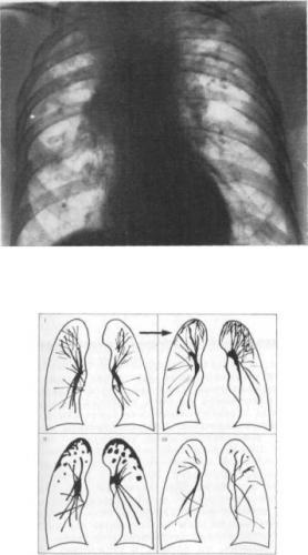 Диффузный пневмосклероз: признаки, симптомы, диагностика и лечение