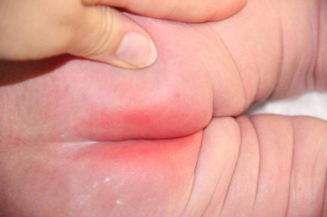 Красная попа вокруг ануса у новорожденного и грудничка