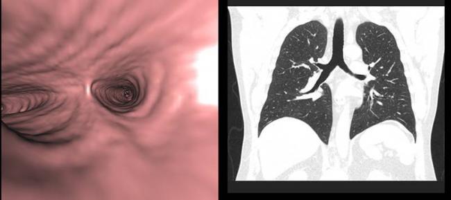 Пневмофиброз?