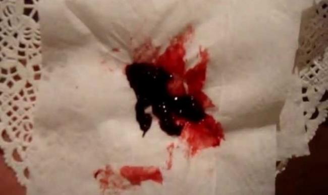 Кровь в мокроте при бронхите