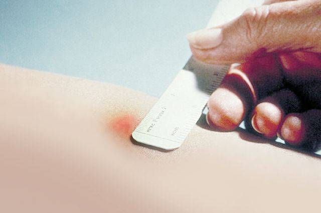 Аналог реакции манту который сейчас делают вместо прививки ребенку