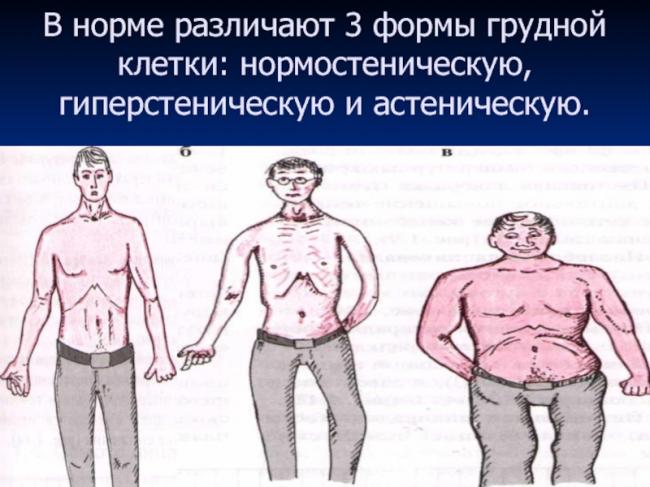 Виды деформаций грудной клетки – выясняем название деформации