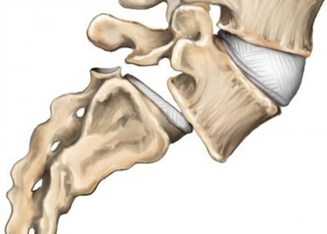 Спондилолистез