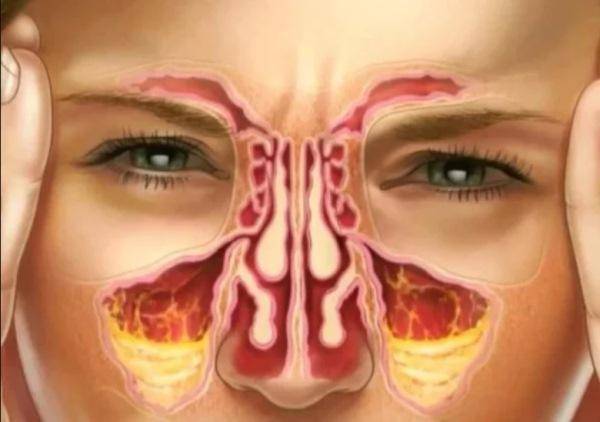 Лечение гайморита народными средствами, лекарствами и процедурами
