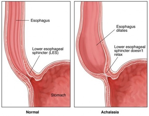 Что собой представляет ахалазия кардии (кардиоспазм)