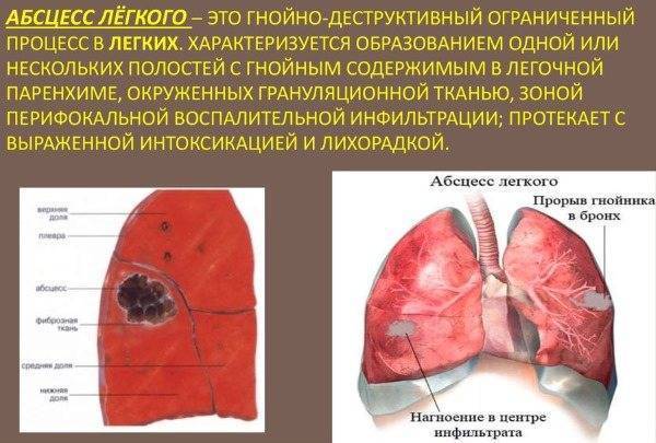 Почему при кашле появляется мокрота с кровью – связь с заболеваниями
