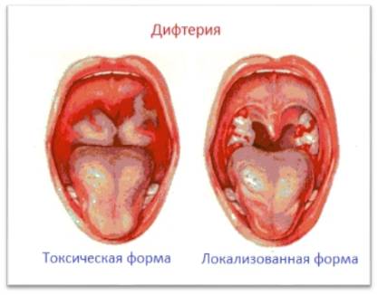 Воспаление гланд: методы лечения