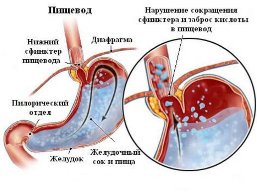 Дуодено-гастральный рефлюкс: причины, симптомы, диагностика, какими препаратами проводится лечение желчного рефлюкса