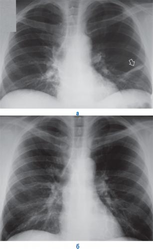 Ателектаз легкого: виды, причины, симптомы и лечение — симптомы