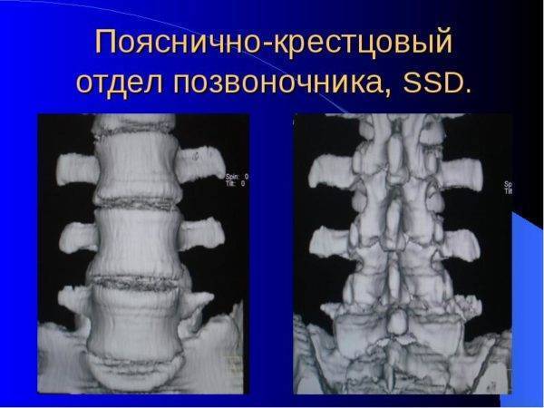 Ортопедический пояс для спины при болях в пояснице, виды медицинских корректоров
