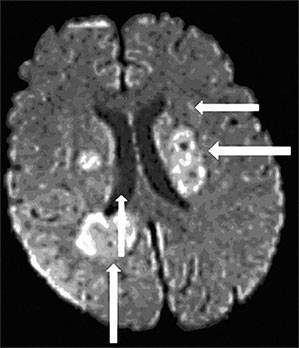 Застойная пневмония у лежачих больных: симптомы, лечение, профилактика