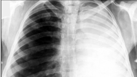 Ателектаз легкого: виды, причины, симптомы и лечение