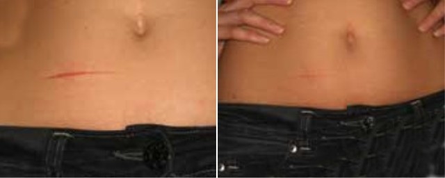 Дерматикс (мазь, гель)