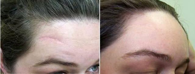 Дерматикс (мазь, гель)