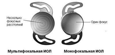 Интраокулярные линзы (иол): особенности, материалы изготовления
