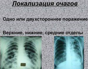 Очаги на кт легких