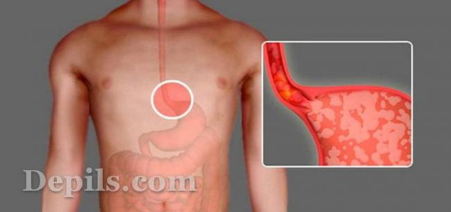 Ахалазия кардии