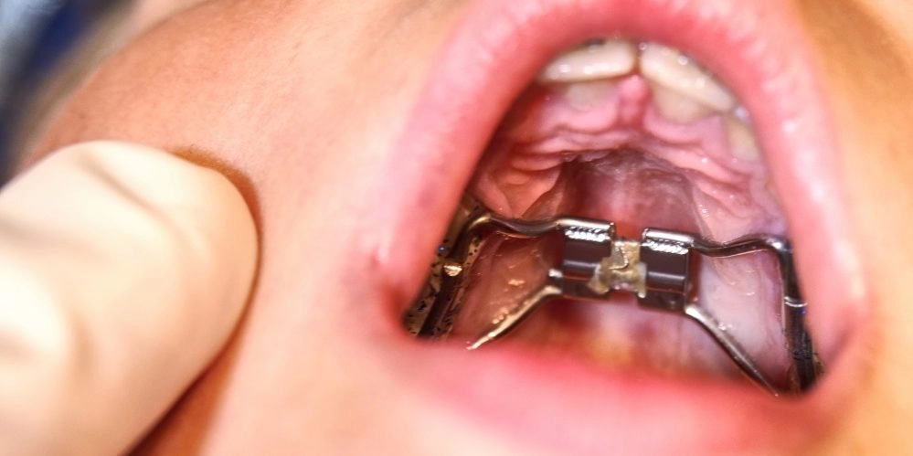 Болит горло с левой стороны больно глотать что делать