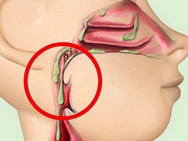 Как откашлять мокроту из горла?