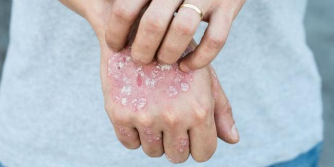 Диета пегано при псориазе