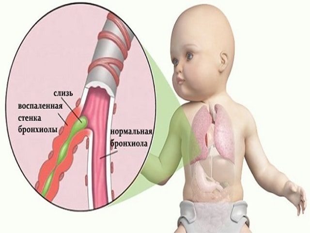 Как вылечить бронхит у ребенка 1-2 лет раз и навсегда!