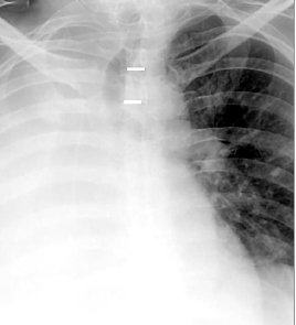 Ателектаз – описание, причины, симптомы, прогноз, лечение