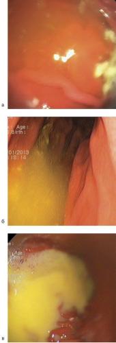 Дуоденo гастральный рефлюкс