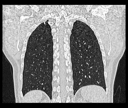 Помогите с расшифровкой кт легких ребенка - вопрос пульмонологу - 03 онлайн