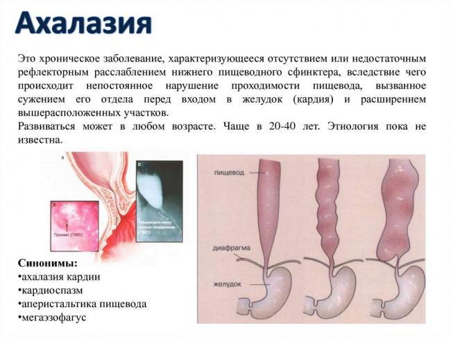 Недостаточность кардии желудка – причины, симптомы ахалазии кардии пищевода