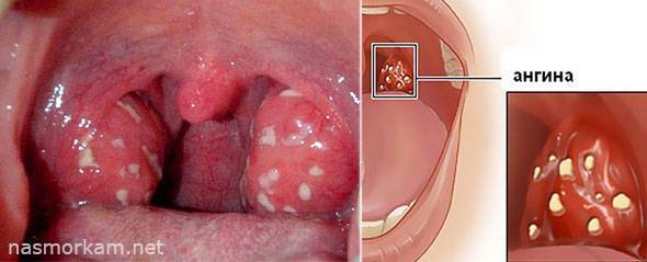 Боль в горле слева при глотании