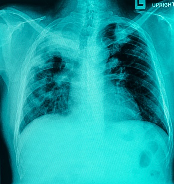 Ателектаз легкого