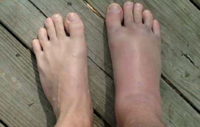 Цефазолин инструкция по применению