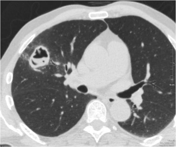 Помогите расшифровать данные кт легких