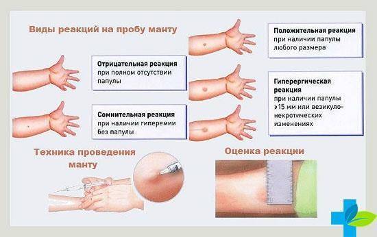 Диаскинтест или манту: что лучше, преимущества и недостатки