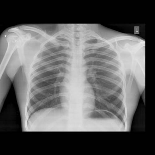 Помогите с расшифровкой кт легких ребенка