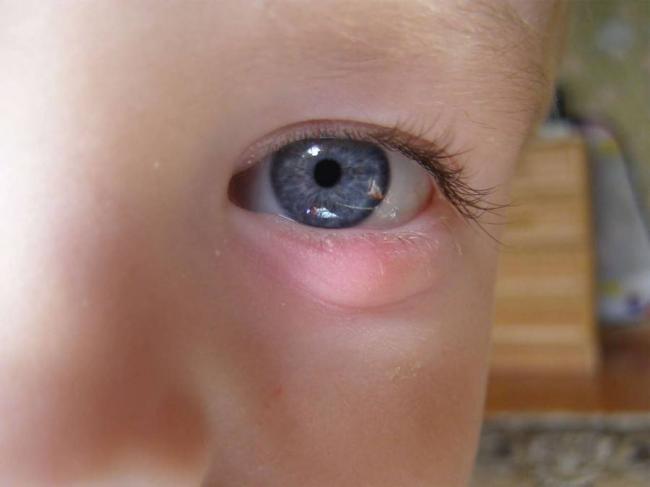 Бактериальный конъюнктивит глаз лечение у взрослых капли