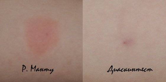 Кому точно нельзя делать манту, список противопоказаний? не навредите ребёнку