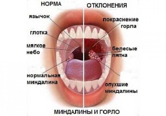 Как победить хронический тонзиллит – схема лечения миндалин