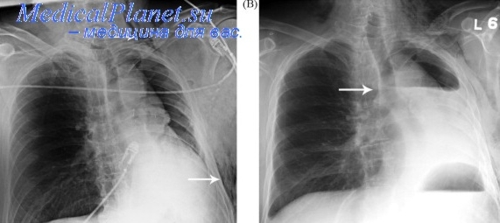 Ателектаз легкого — что это такое, причины, лечение, симптомы