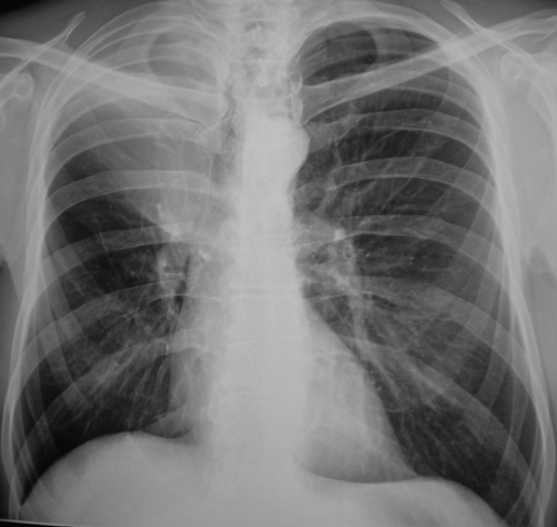 Ателектаз легкого 4.95/5 (19)