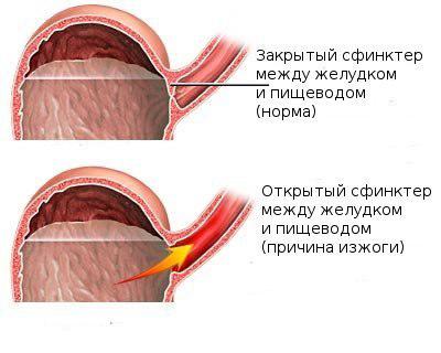 Симптомы заболевания и лечение недостаточности кардии желудка