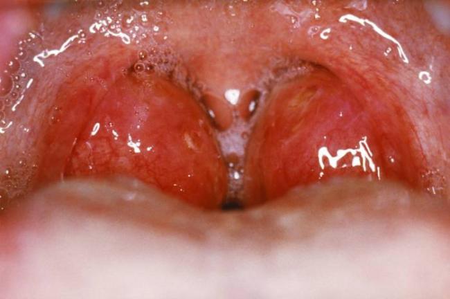 Почему болит гланда с одной стороны и чем лечить воспаленную миндалину?