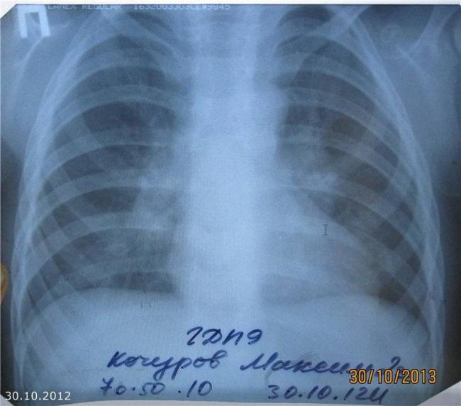 Развитие прикорневой пневмонии у взрослых и детей: симптомы и этиология