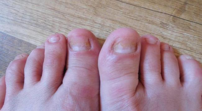 Микоспор от грибка ногтей