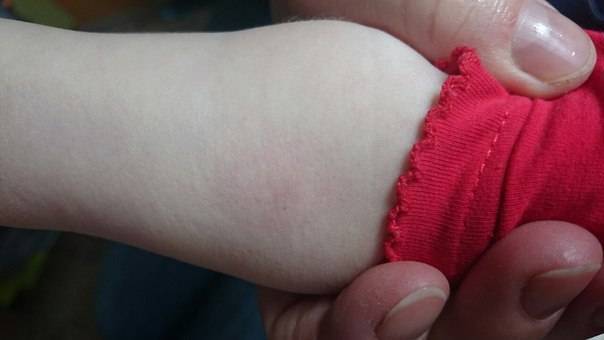 Как часто встречается аллергия на пробу манту