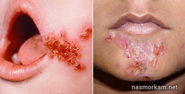 Боль в горле слева при глотании