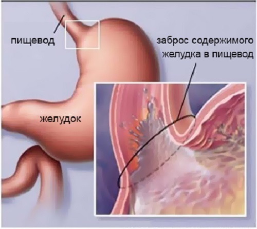 Дуодено-гастральный рефлюкс: что это такое, причины, симптомы, диагностика и лечение (диета, препараты, народные средства)