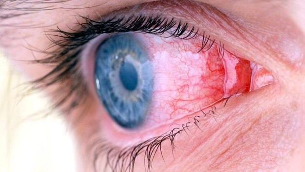 Лечение конъюнктивита: препараты, народные средства | food and health