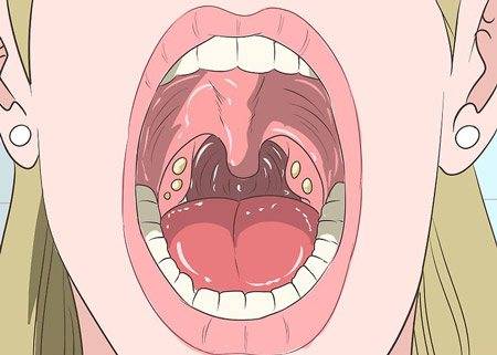 Методы лечения хронического тонзиллита у взрослых – профилактика